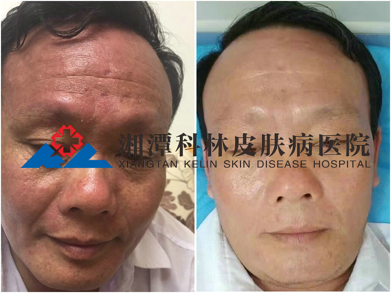 我院治疗颜面再发性皮炎案例